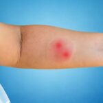 prikaz ujeda od pauka na dečijoj ruci