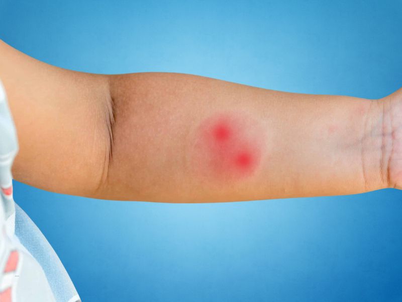 prikaz ujeda od pauka na dečijoj ruci