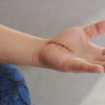 dete sa ušivenom ranom na ruci