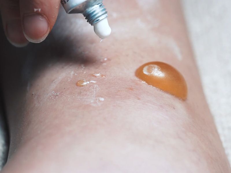 osoba maže kremu na opekotinu