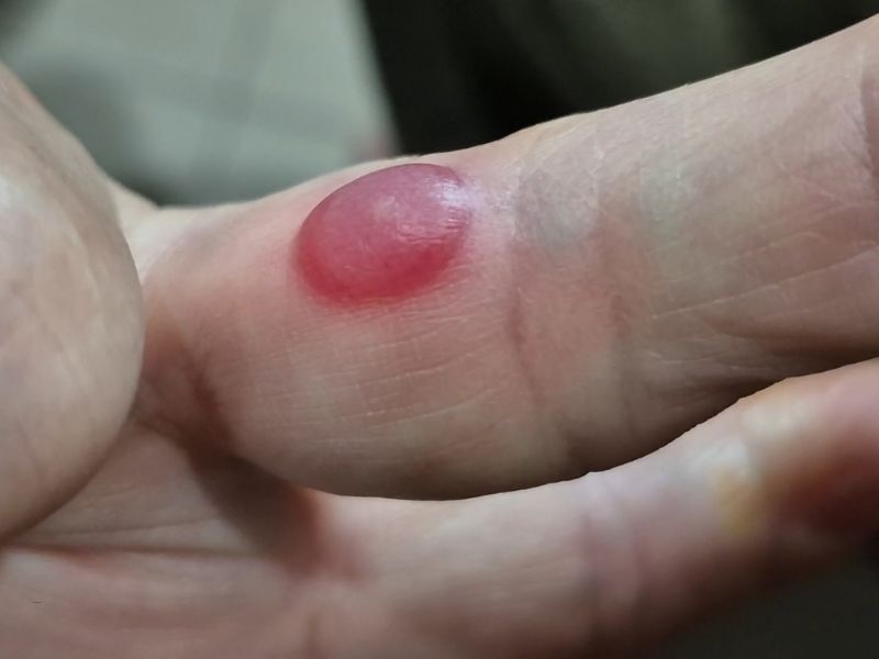 opekotina na prstu