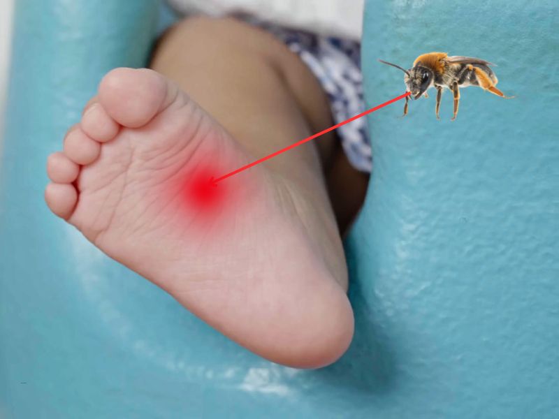 prikaz dečije noge, pčele i upaljenog mesta na kom je pčela ujela dete