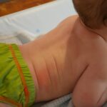 prikaz bebe koja pati od atopijskog dermatitisa