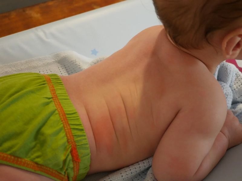 prikaz bebe koja pati od atopijskog dermatitisa