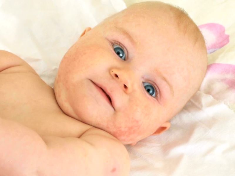 beba sa atopijskim dermatitisom 